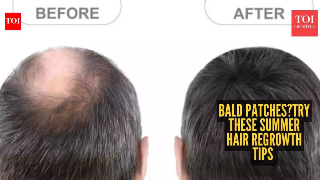 5 easy summer hair regrowth tips for bald patches