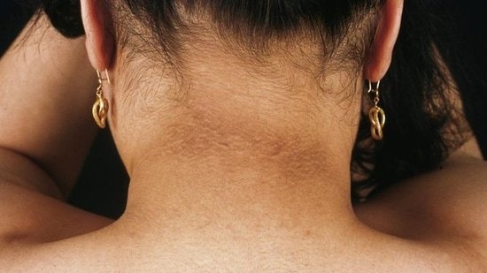 Maryland doctor explains why some have dark and velvety skin in neck and underarms: ‘It is not a hygiene issue…’
