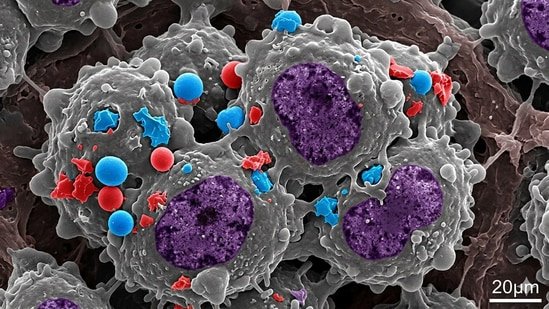 Did you know microplastics have been found in colon cancer cells? Gastroenterologist shares 7 ways to minimise exposure