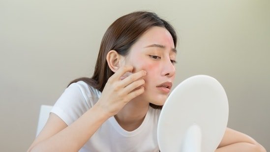 What foods cause acne? Dermatologist suggests removing these from your diet for clearer skin: Biscuits to white bread