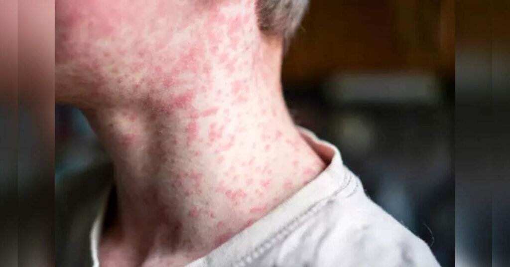 Cases Surge to 996 Amid Vaccination Concerns, ETHealthworld