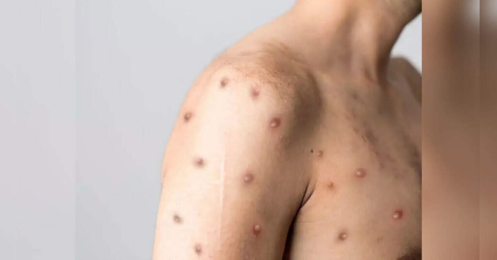 Surge in Chickenpox Cases Prompts Heightened Surveillance in Tamil Nadu, ETHealthworld