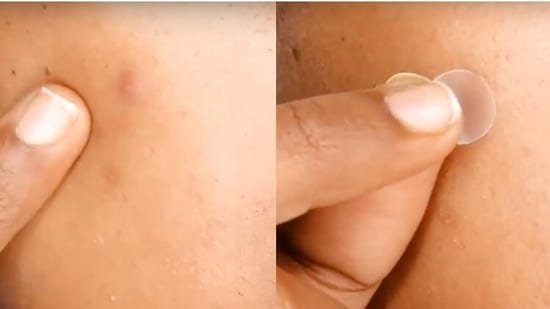 Don’t let a sudden pimple outburst ruin your date: 7 acne patches you should keep handy