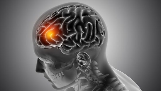 Kolkata neurosurgeon with over 36 years of experience explains brain tumour symptoms often misread as migraine, stress