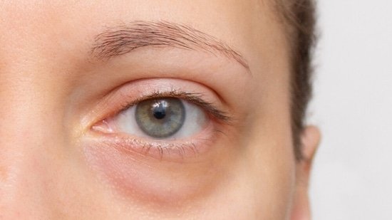Hot weather makes your eyes look tired? Doctor shares tips to manage puffiness and dark circles