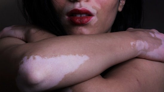 Can vitiligo spread? Dermatologist explain what really causes new white patches to appear