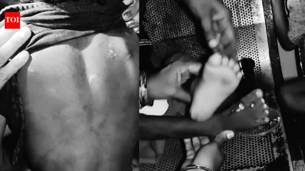 Branded, burned: Suryapet couple held for torturing 2 young sons | Hyderabad News