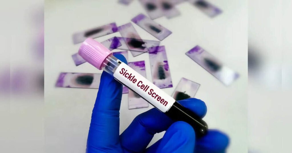 Over 7.25 Crore Sickle Cell Anaemia Screenings Conducted in Tribal Areas, ETHealthworld