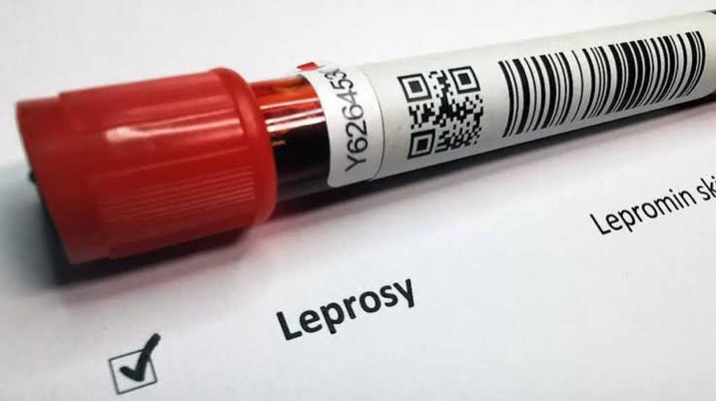 J&K declares leprosy ‘Notifiable Disease’