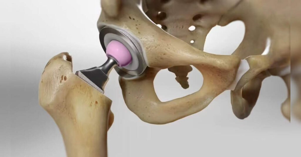 Revolutionary Dual-Mobility Hip Implant Reduces Dislocation Risk by 70%, ETHealthworld