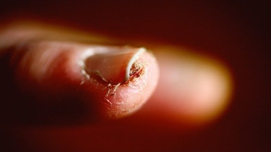 Yellow, thickened nails? Dermatologist Dr Vishalakshi explains the early signs of a fungal infection