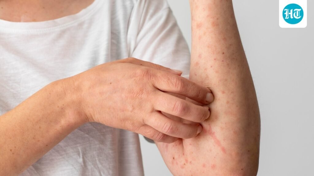 Got a red, itchy rash this monsoon? Dermatologist explains why your skin reacts during the humid season
