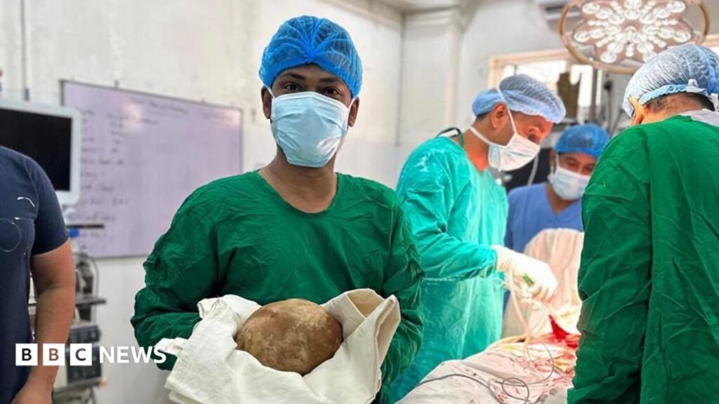 Sri Lanka: Doctors remove 3.1kg stone from man’s bladder