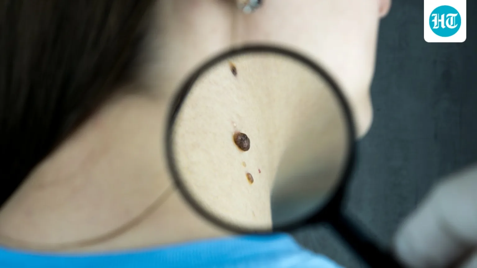 From size and location to changes over time: Oncologist explains when a lump needs attention