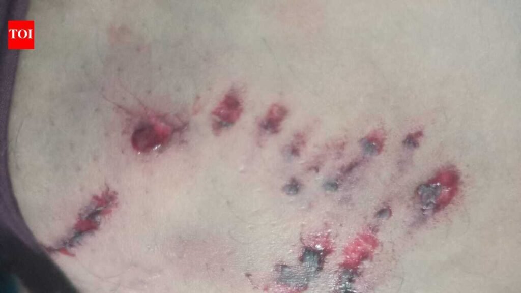 Rabid dog bites 43 in Kalol over weekend; put down by civic authorities | Vadodara News