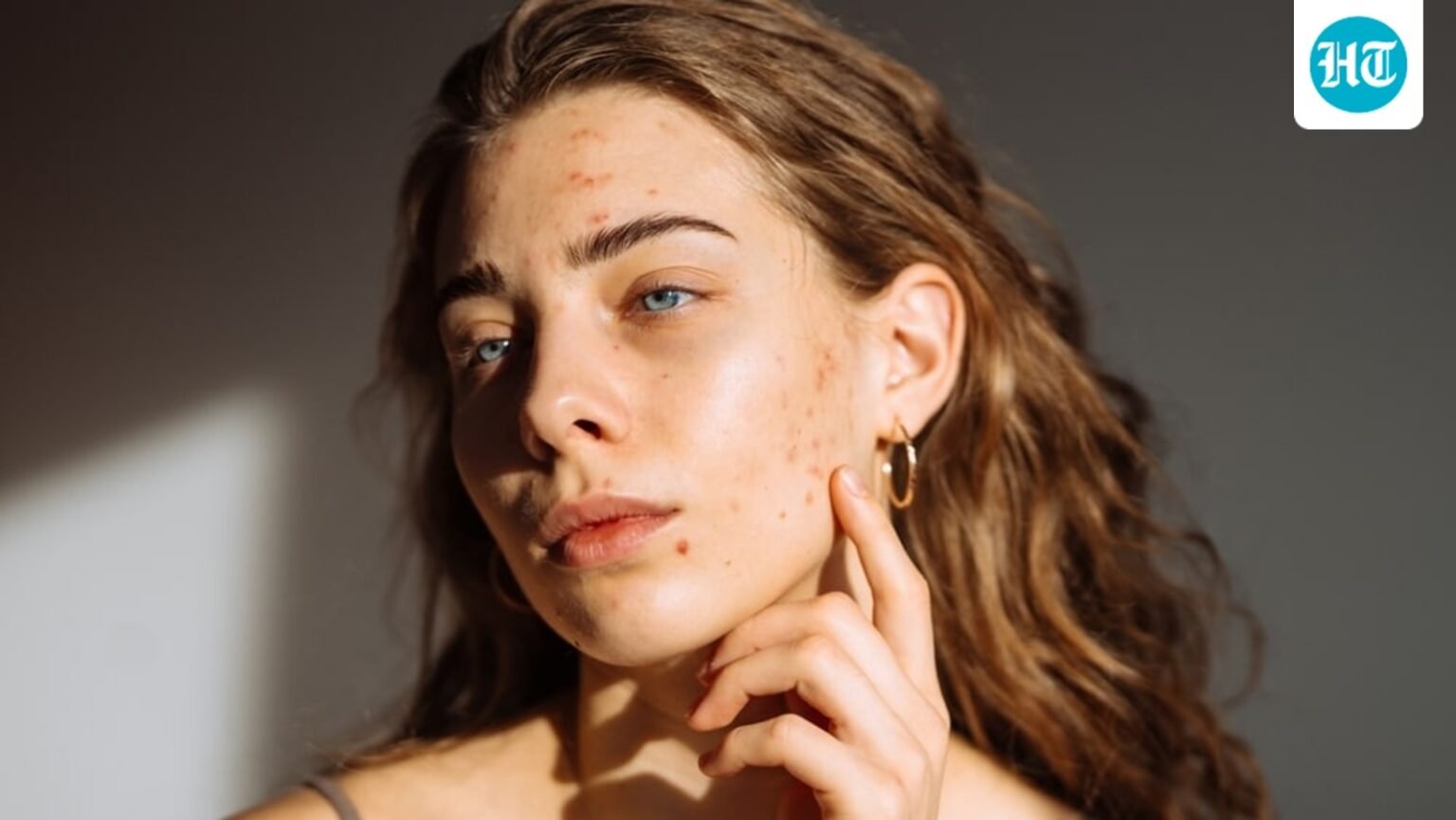 Why does your acne keep coming back? Dermatologist lists 5 daily triggers, from dirty pillowcase to unclean phone