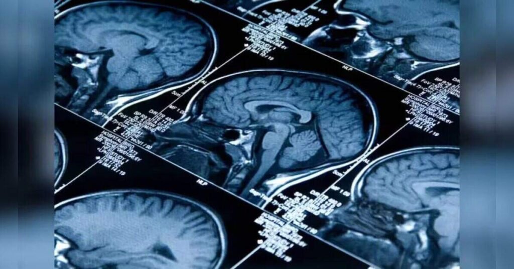 Brain Activity Revealed by UCSF Study, ETHealthworld