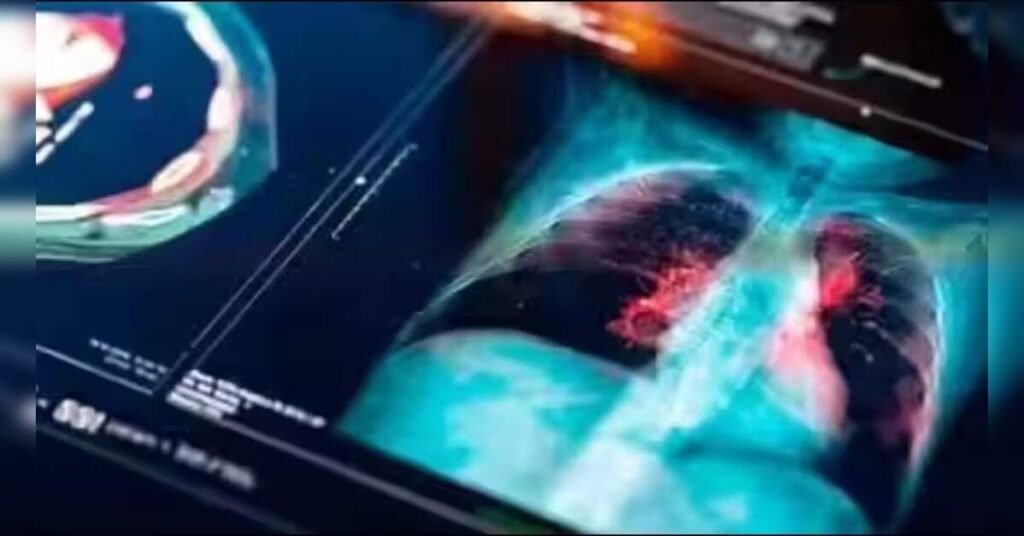 Revolutionary Study Shows 16% Drop in Lung Cancer Deaths with Low-Dose CT Screening, ETHealthworld