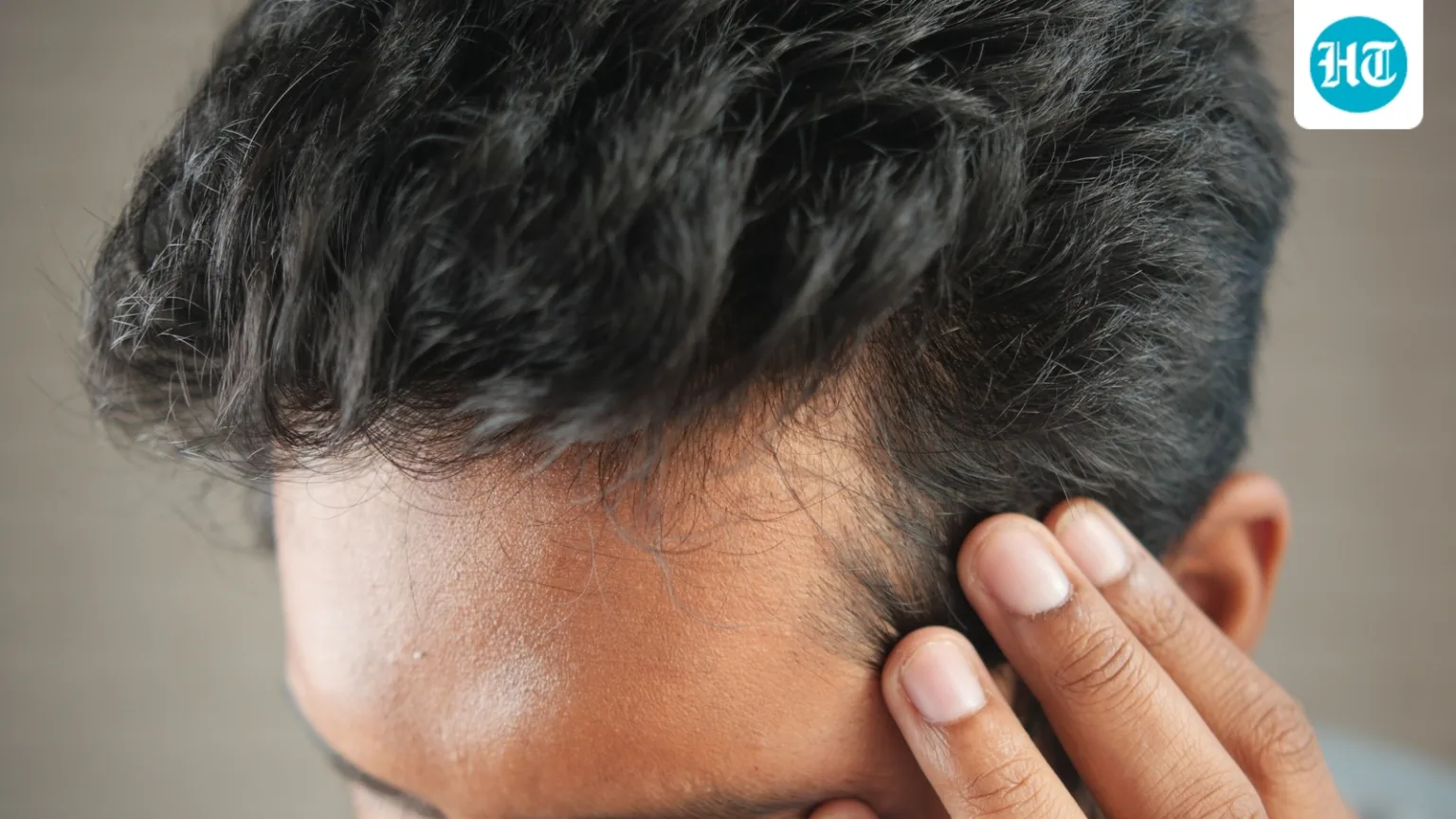 Why are young men losing hair earlier? Expert decodes the role of genetics, stress, diet, and creatine