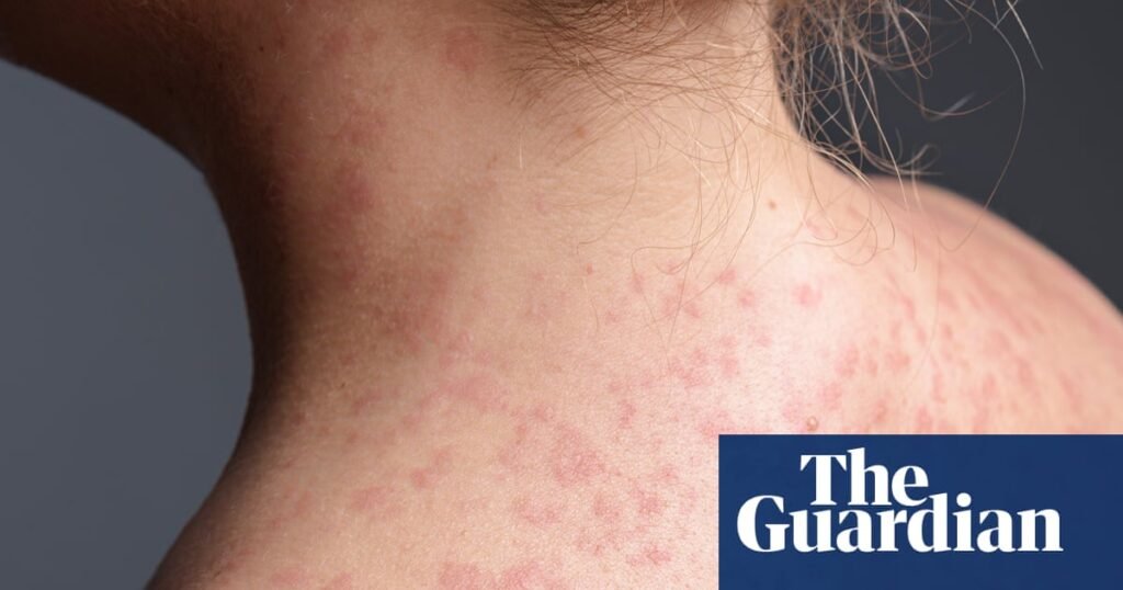 Pennsylvania faces largest measles outbreak in decades as case count rises to 1,000 | Pennsylvania