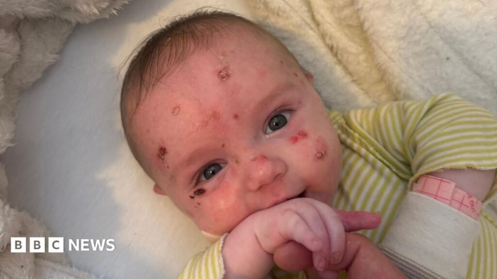 Epidermolysis bullosa: I was told my baby was as fragile as glass