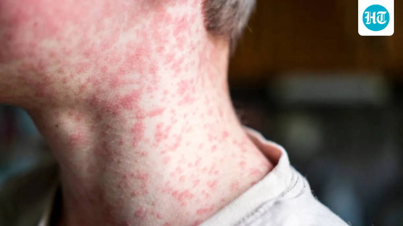 Skin rashes in children: Paediatrician explains common causes, warning signs and when parents should worry