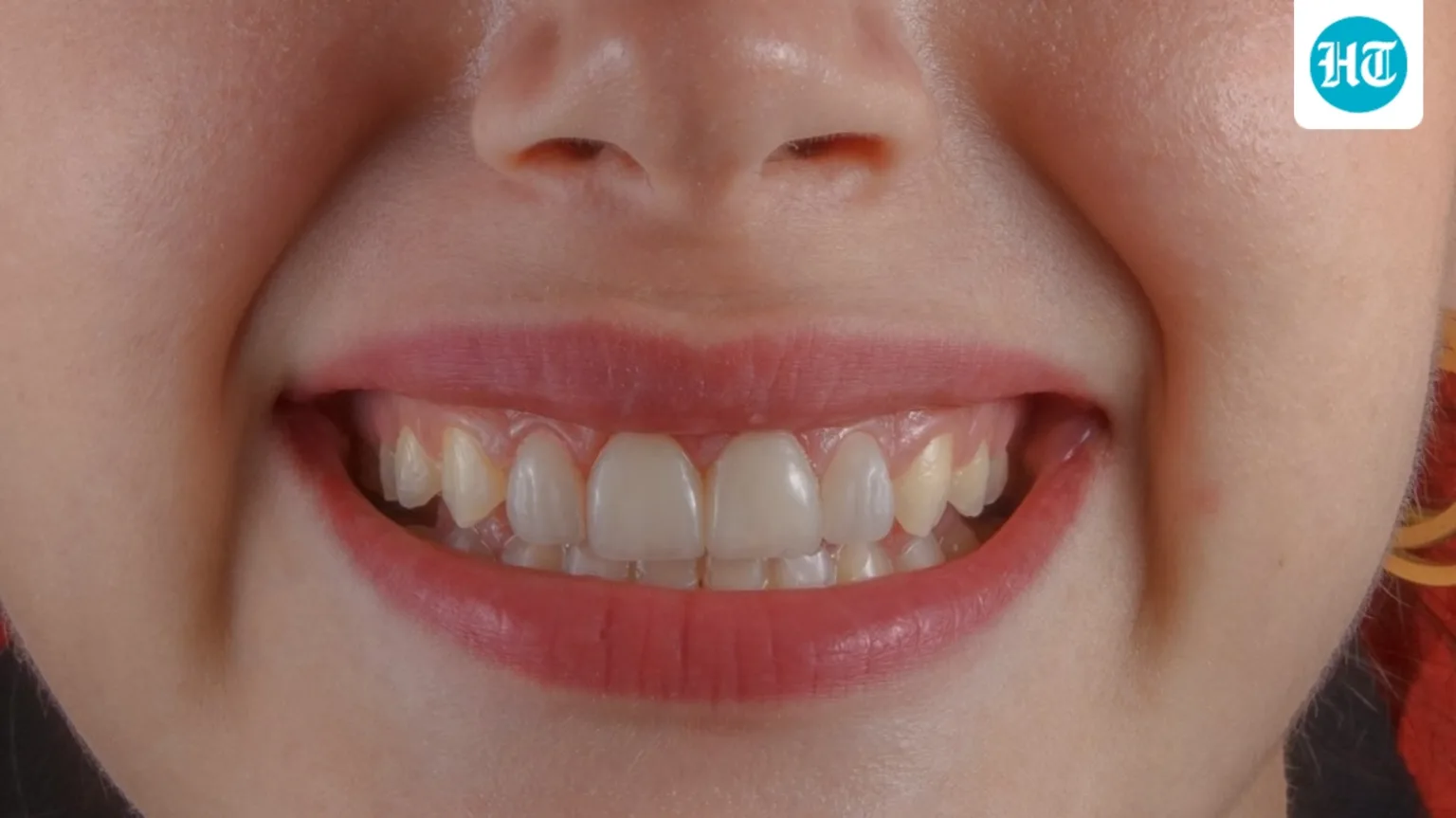 Why do your teeth develop tiny rough edges as you get older? Dentist explains common causes and habits to watch out for